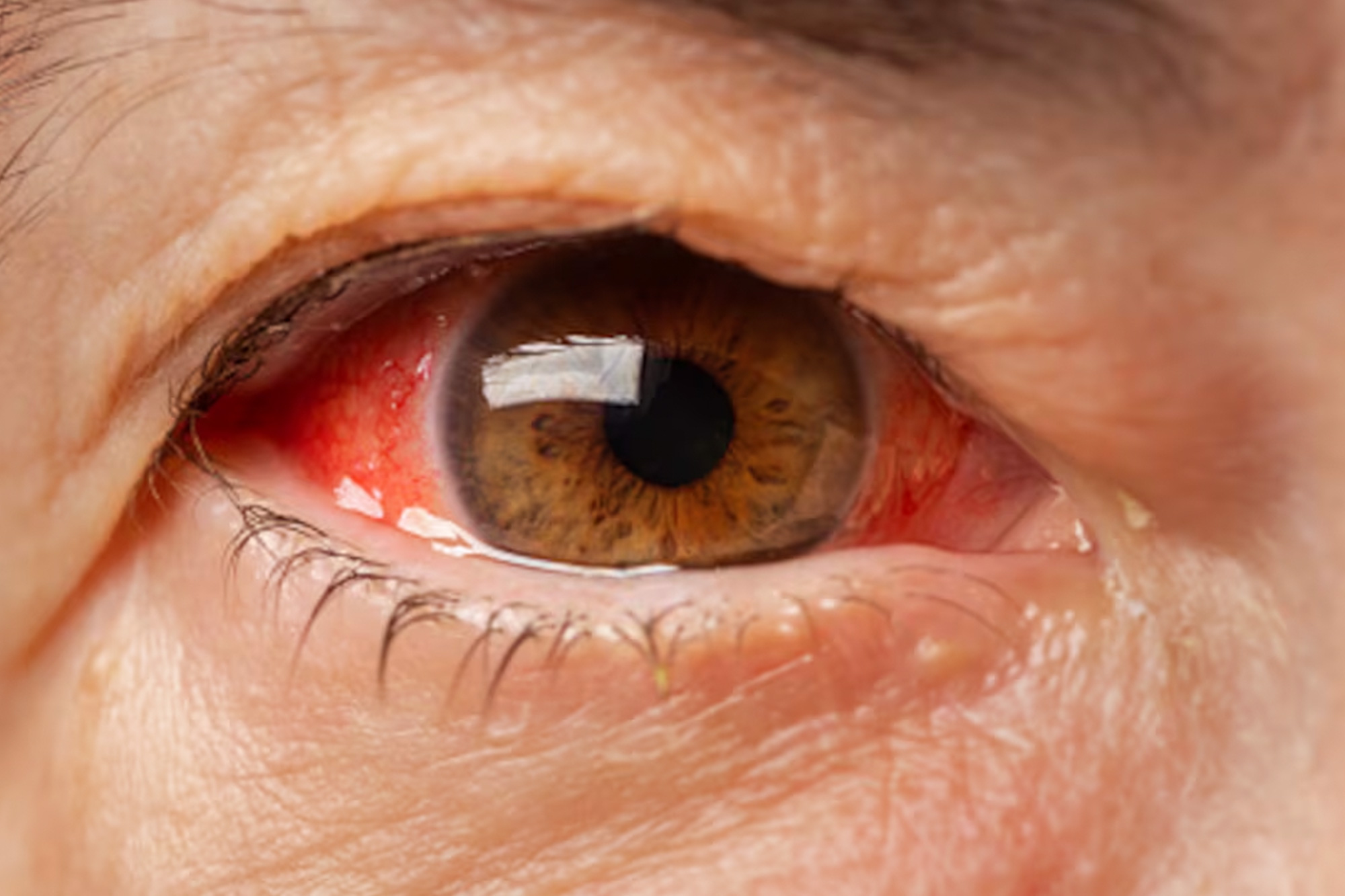 Glaucoma