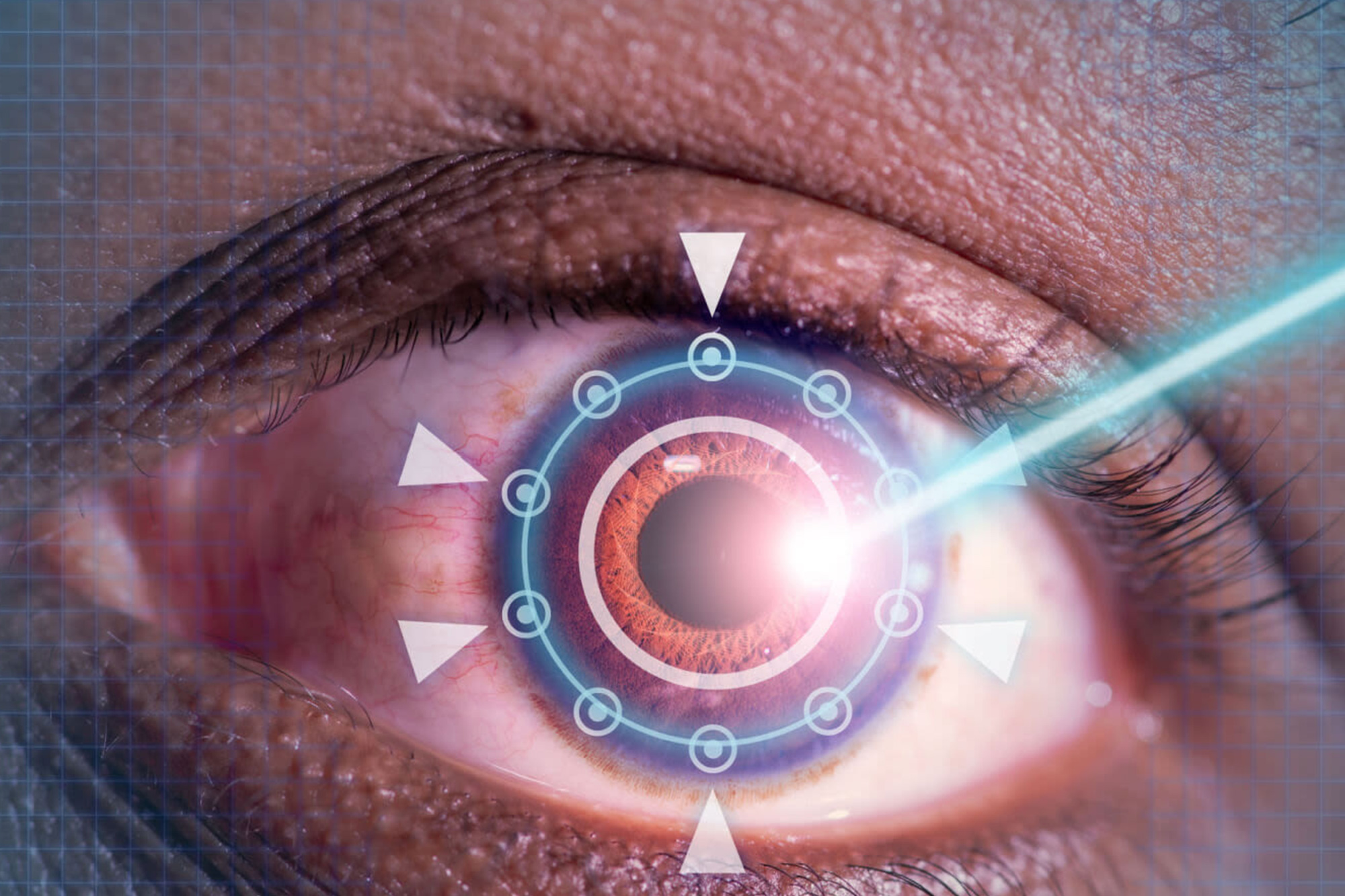 Lasik